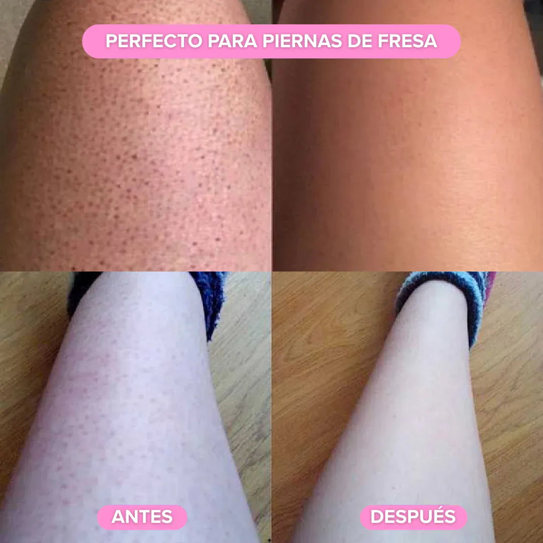 Depiladora Anivelle®